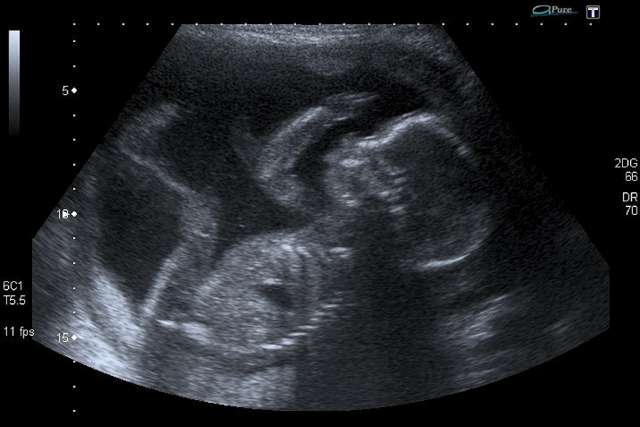 U.S. House to vote on banning abortion after 20 weeks